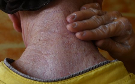 Ensuring Essential Sun Protection for Persons with Albinism